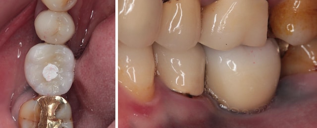 牙周病治療推薦: 療程包含全口牙周病/全瓷冠假牙/陶瓷貼片/植牙 4