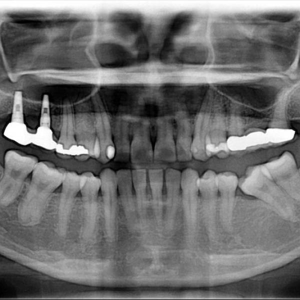 中度牙周病治療推薦 全口牙周病牙冠增長術鼻竇增高術